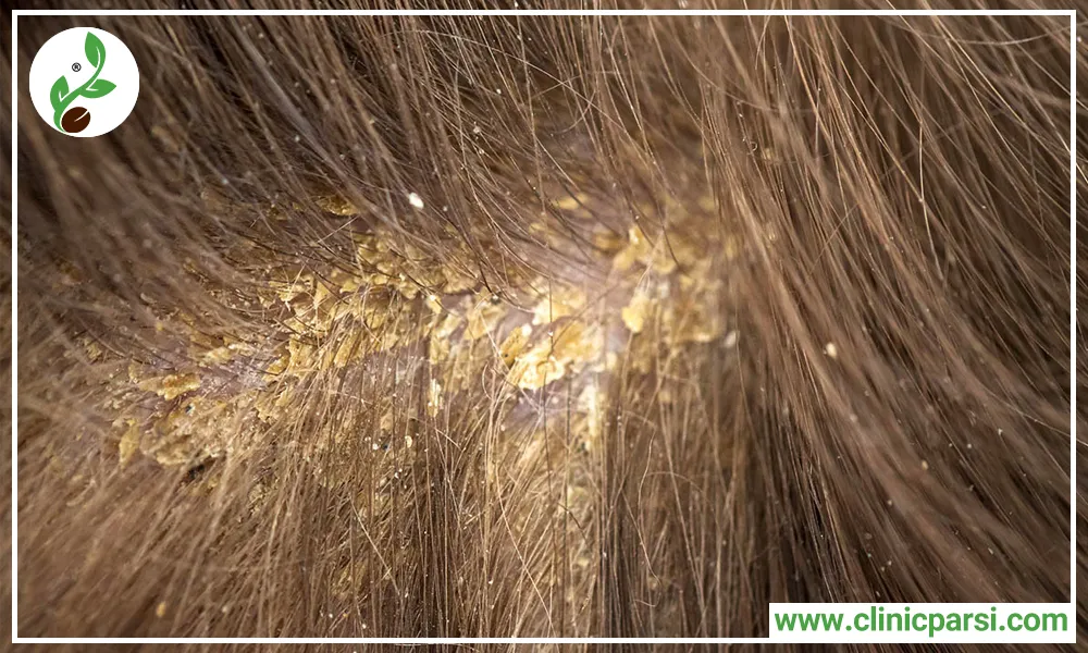 عکس شوره سر - علت پوسته شدن سر بعد از کاشت مو